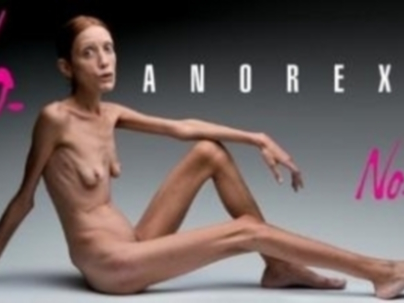 Una mujer desnuda está sentada con las piernas extendidas, mostrando una figura delgada y desnutrida. La imagen tiene el texto "No Anorexia" en letras grandes y rojas, con la palabra "Nolita" en letras pequeñas y rosadas.