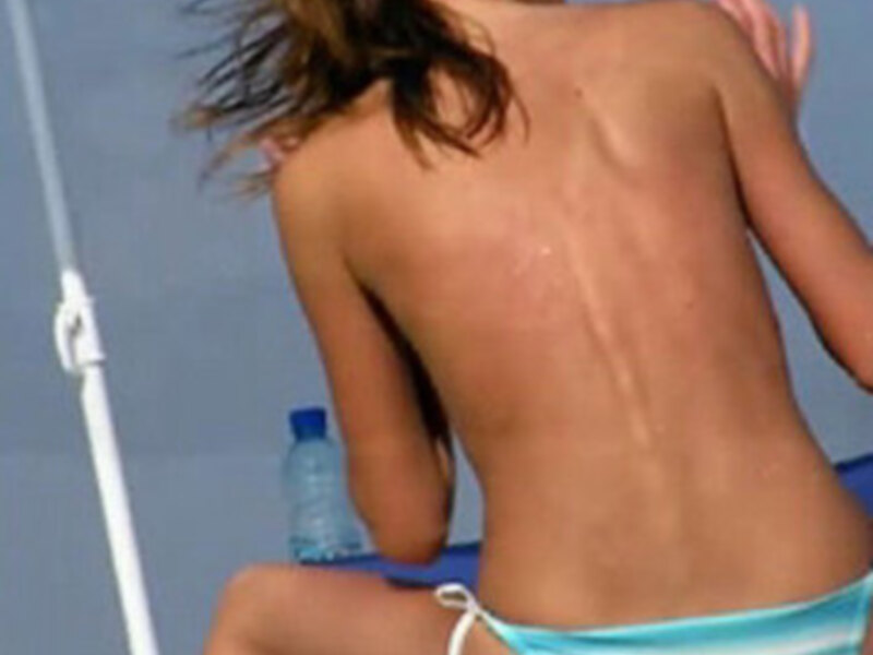 Una mujer con bikini azul y blanco se sienta en la arena de un campo de tenis, mostrando su espalda desnuda con una cicatriz. En el fondo, se puede ver una botella de agua y un poste blanco.